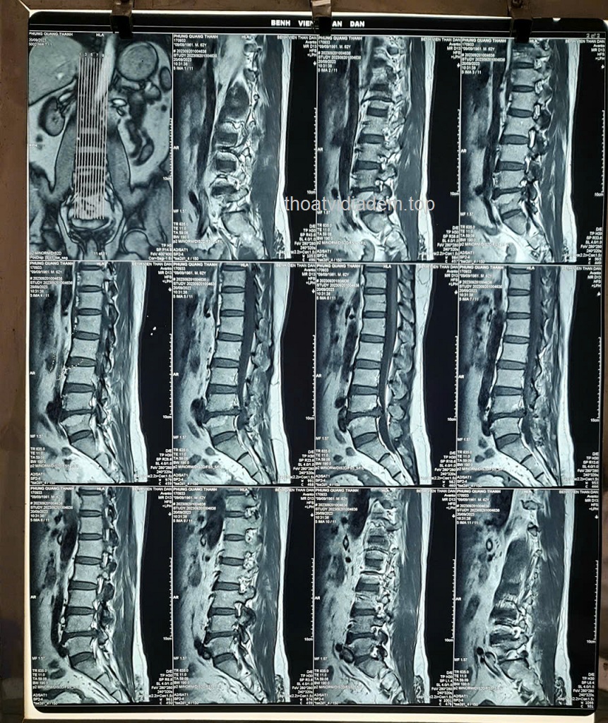 Thoát vị đĩa đệm L4 L5